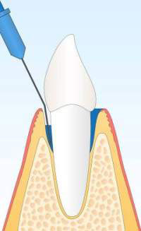 photodynamischer Softlaser