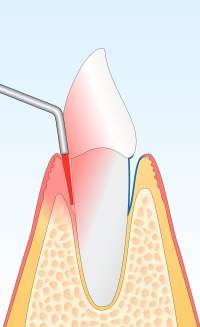 photodynamischer Softlaser